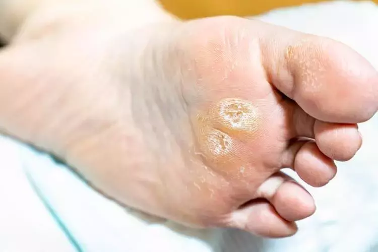 mantarin kokunu kurutuyor nasir egzama ve mantara 5 dakikada cozum 0 C13DM5dG